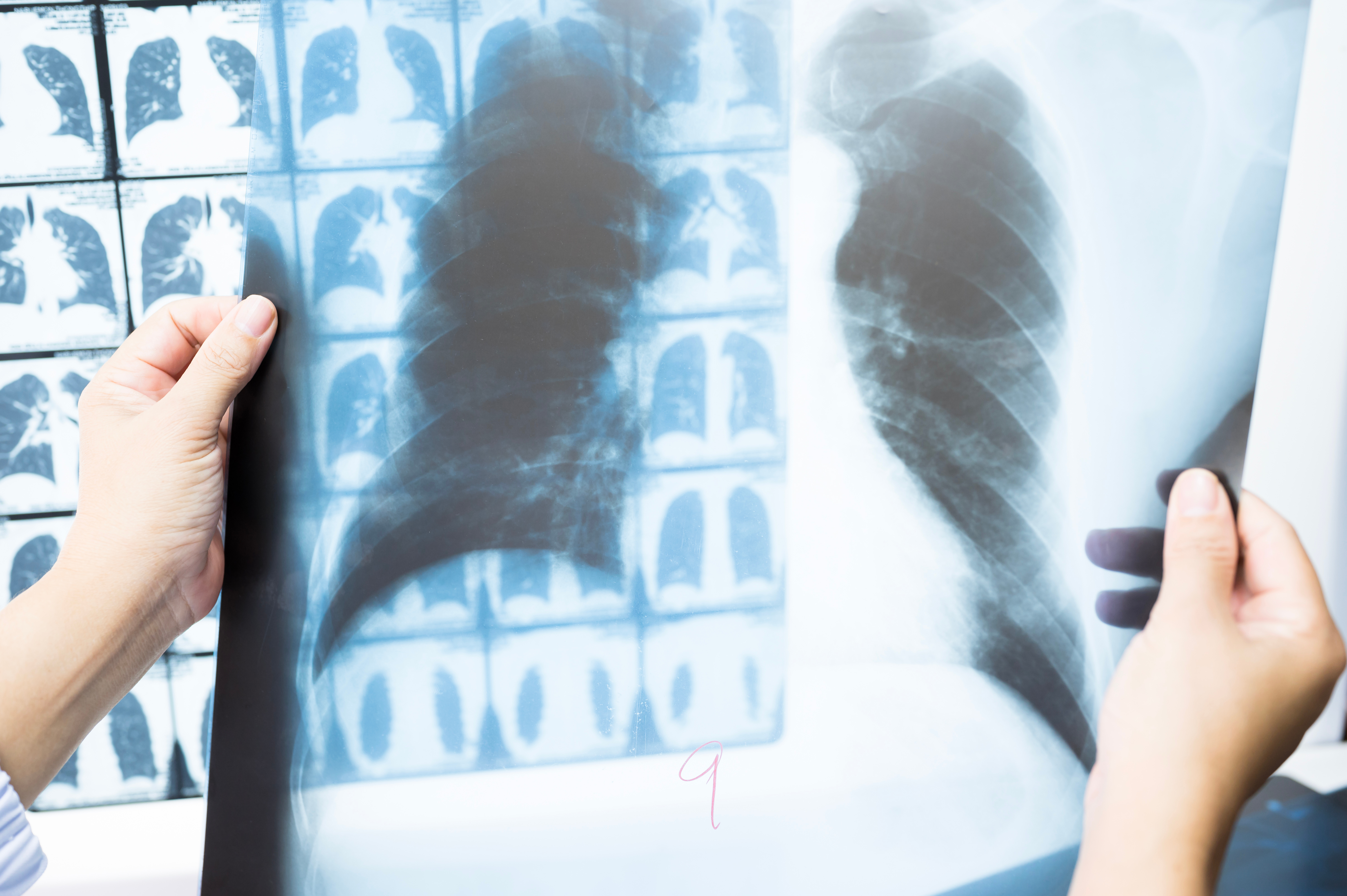 lung cancer x ray
