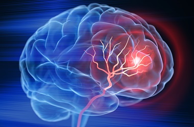 Advanced Imaging Provides Precision Lens for Treating Stroke