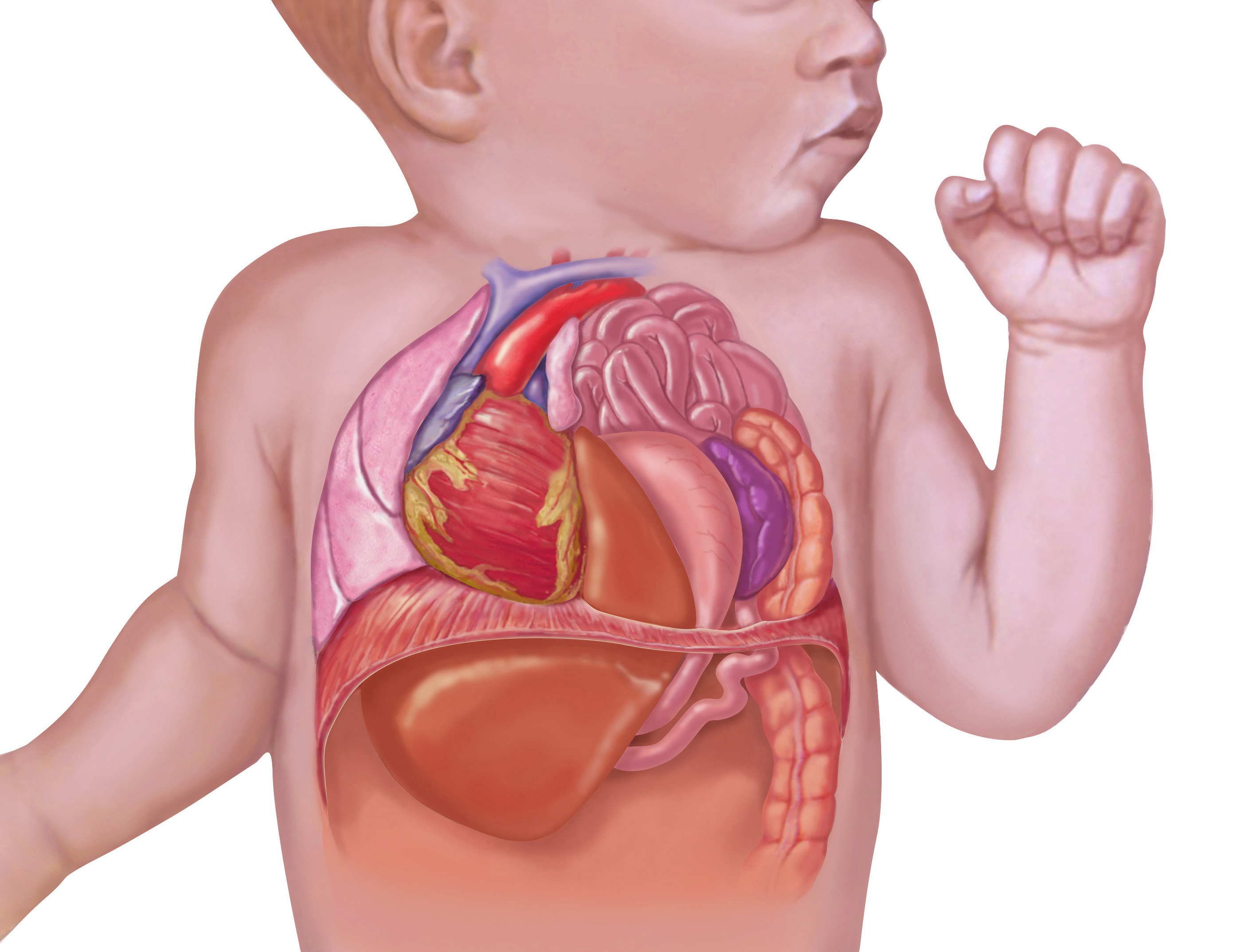An illustration showing CDH in a baby