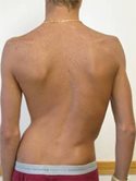 A photo of scoliosis.
