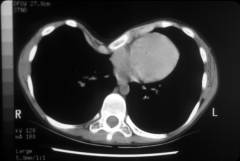 CT scan showing the sunken in breastbone.