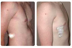 Picture of a patient before and after repair of the pectus excavatum.
