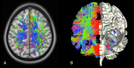 Whole brain tractography with hemi-brain surface.