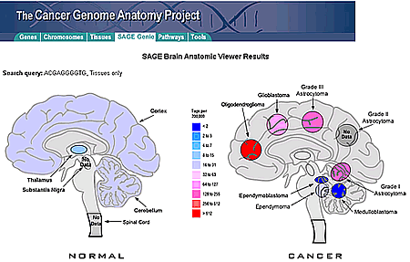 This image shows an example from the ‘SAGE Genie Anatomic viewer’ of a gene that has high expression only in glial tumors.