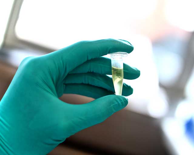 Cerebrospinal fluid may be able to identify aggressive brain tumors in children Featured Slide 4