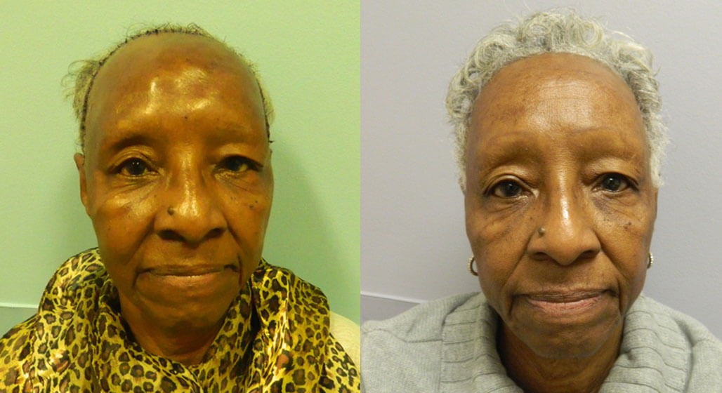 Before and after cranioplasty