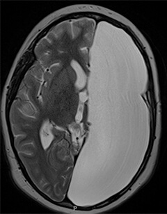 Brain MRI scan after hemispherectomy
