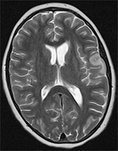Brain MRI scan before hemispherectomy