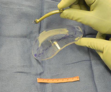 Compact implant shown alongside its neuromodulation device
