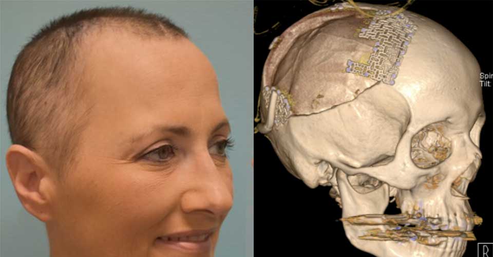Before and after of a skull tumor resection