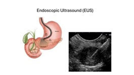 Pancreatic Cancer
