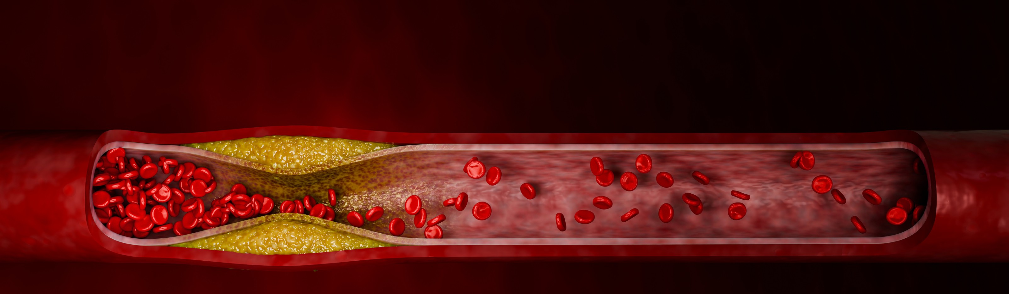 LDL Cholesterol
