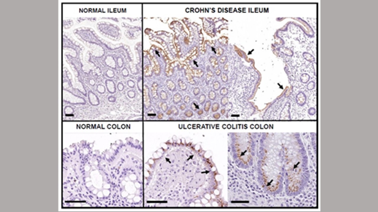 GCPII protein in humans with IBD