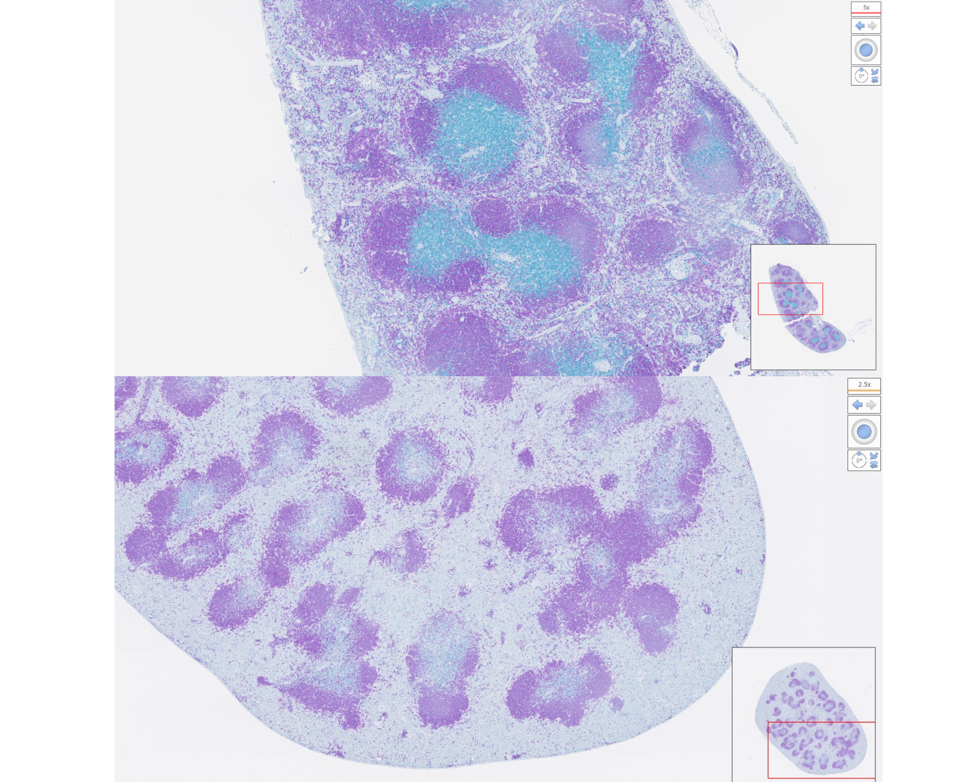 diseased immuneccells