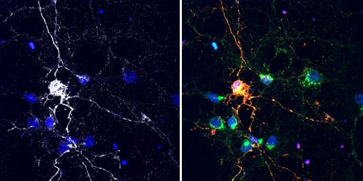 Neurons that express Lag3 proteins (grey/white) can take in Tau proteins (red) compared with neighboring neurons that do not express Lag3. Credit: Xiaobo Mao, Johns Hopkins Medicine