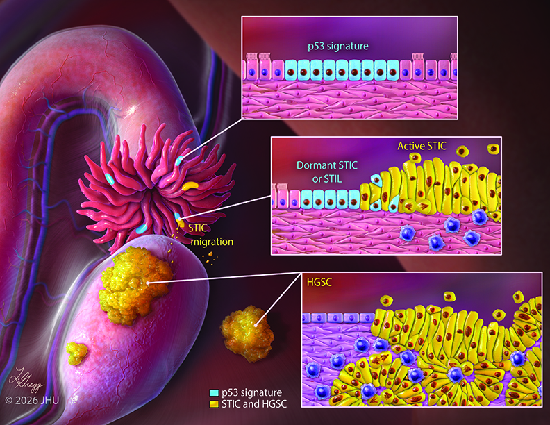 Illustration of ovarian cancer