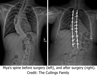scoliosis 