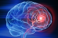 Stroke