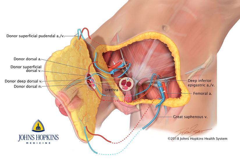 Johns Hopkins Realiza El Primer Trasplante Completo De Pene Y Escroto En El Mundo