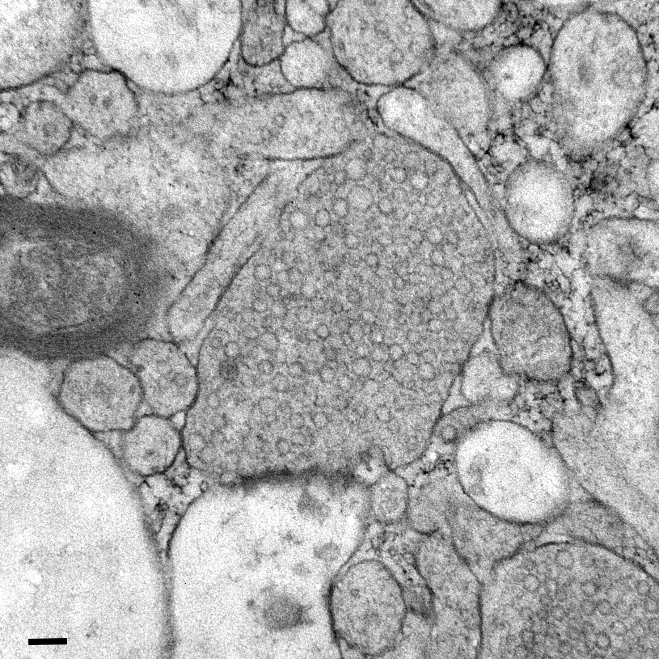 Resected human brain tissue