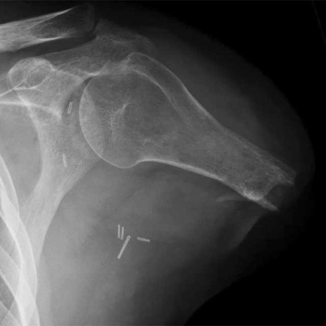 x-ray of shoulder