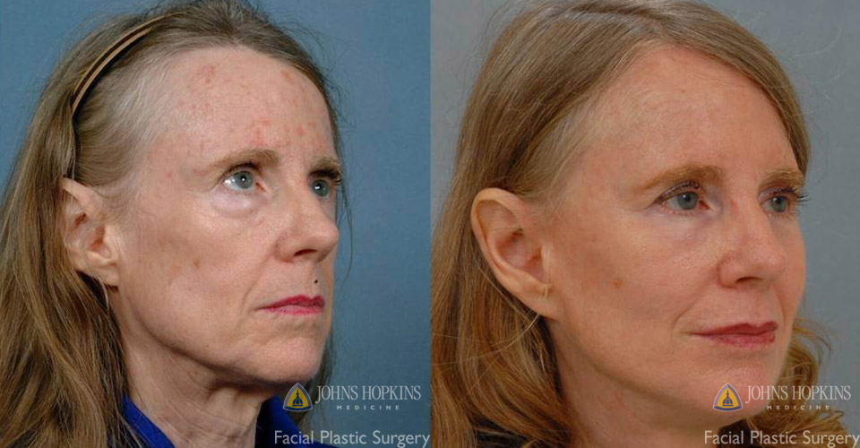 Dermal filler before and after photo of patient. 