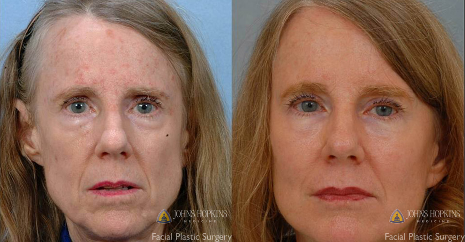 Dermal filler before and after photo of patient. 