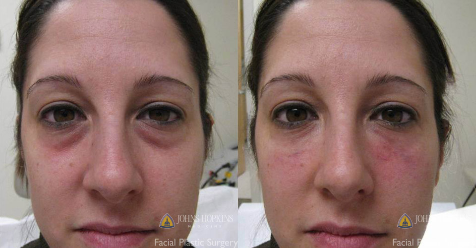 Dermal filler before and after photo of patient. 