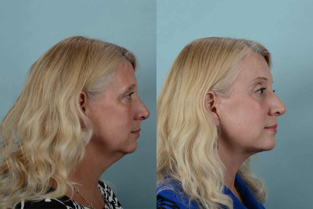 Neck lift before and after. 
