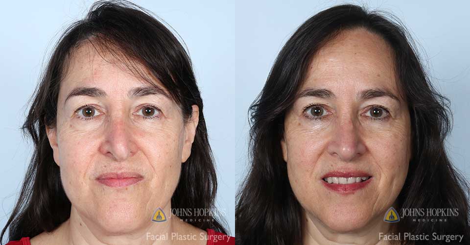  A 63-year-old woman pictured one year after the surgery.