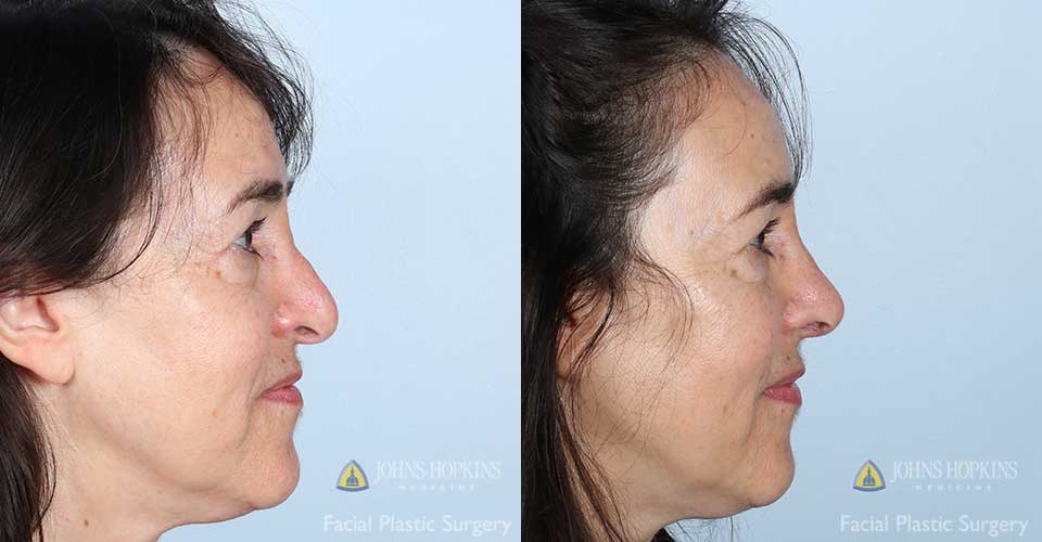  A 63-year-old woman pictured one year after the surgery.