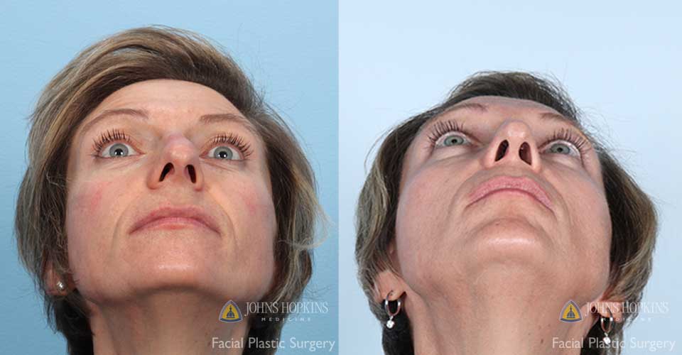 A 49-year-old woman pictured 1.5 years after the surgery.