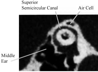 normal CT