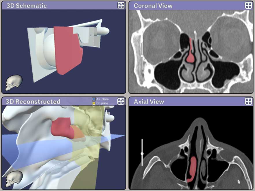 Screenshot from The Johns Hopkins Virtual Sinus Simulator.
