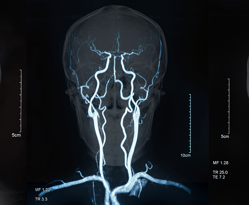 magnetic resonance venography of the brain