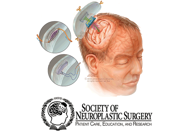 Model of a cranial implant and society of neuroplastic surgery logo