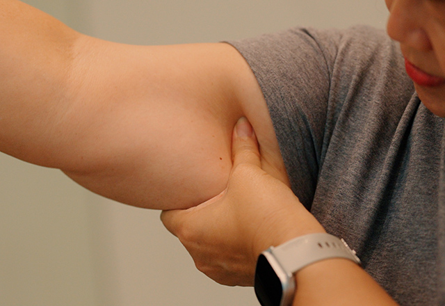 An arm affected by lymphedema