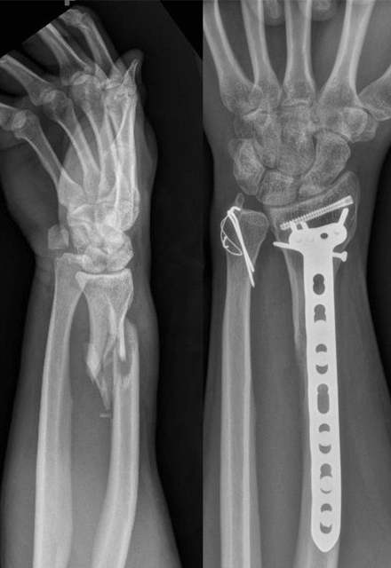imaging of an arm repaired with a metal piece
