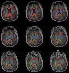 image of a DTI axial fMRI