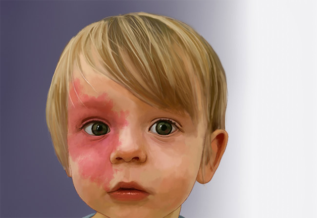 Boy with a vascular malformation