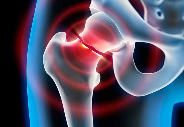 3D illustration highlighting a broken bone in the hip.