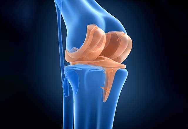 3D illustration highlighting a joint replacement in the knee.