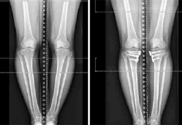 Sibley - Gildenhorn Institute - Knee Alignment