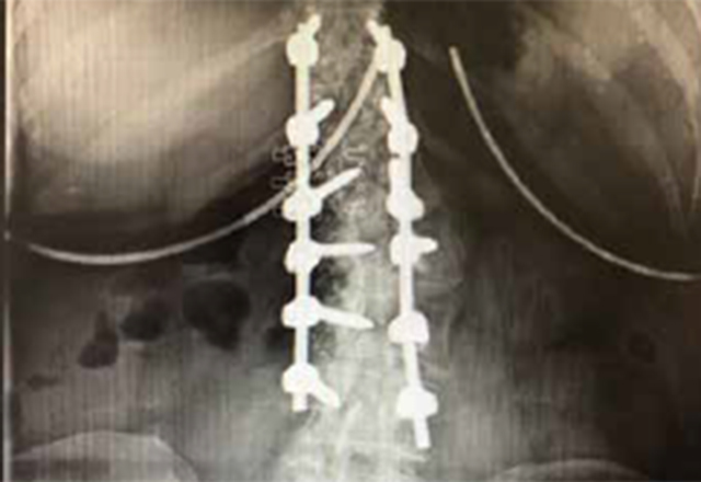 Sibley Gildenhorn Institute Spinal Fusion