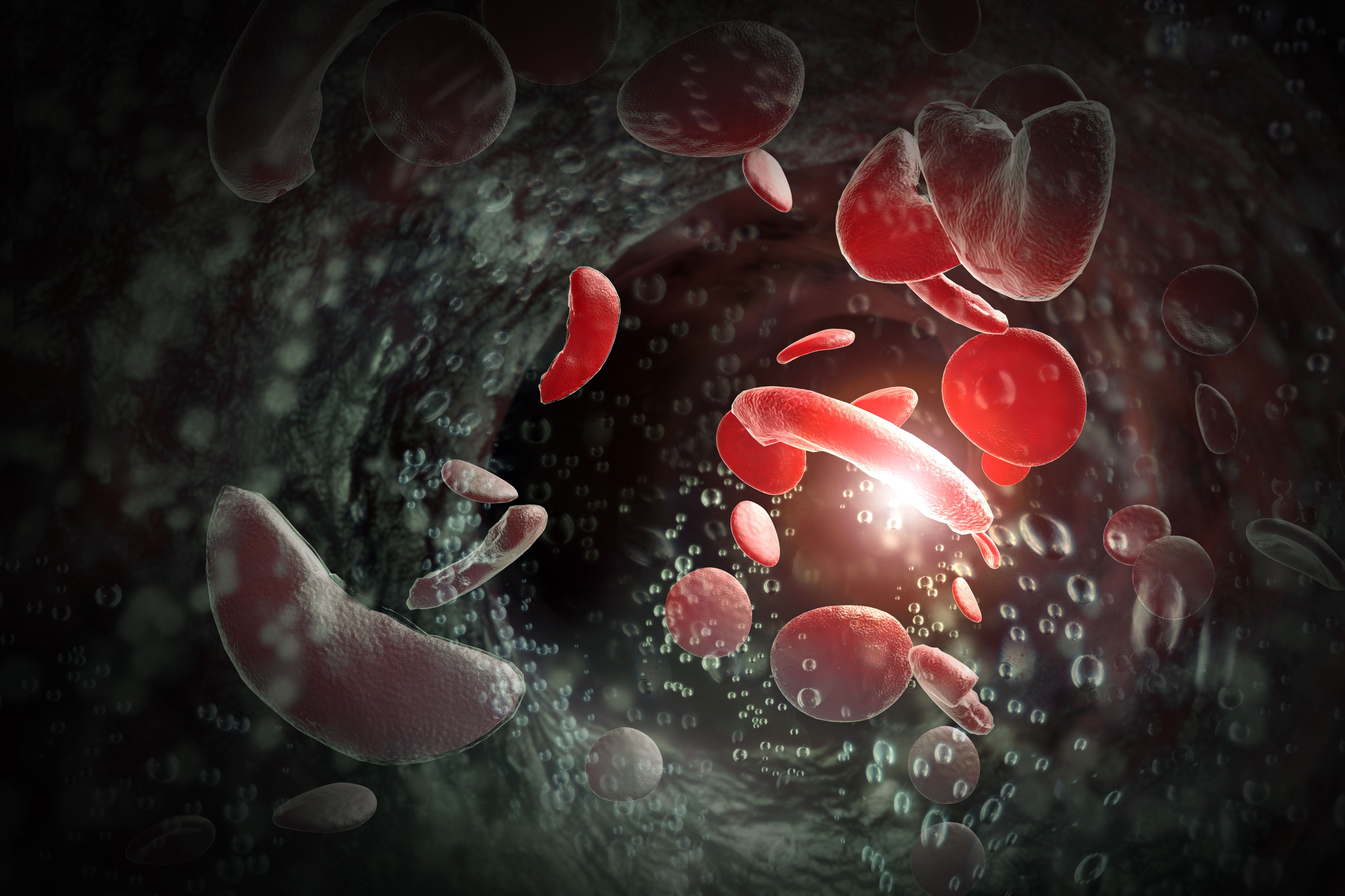 sickle cell disease