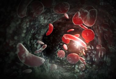 sickle cell