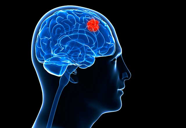 3D illustration showing a brain tumor
