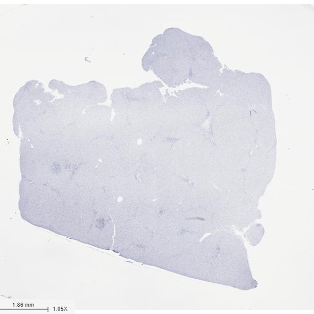 Severe Alcoholic Hepatitis Liver Sample