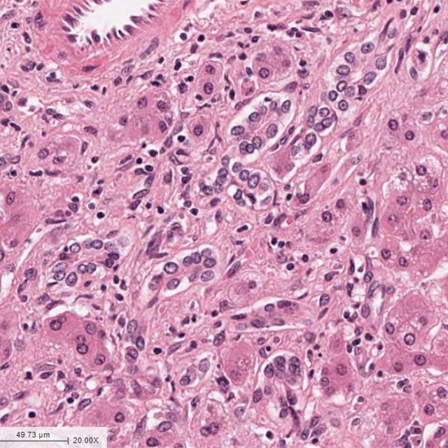 Severe Alcoholic Hepatitis Liver Sample