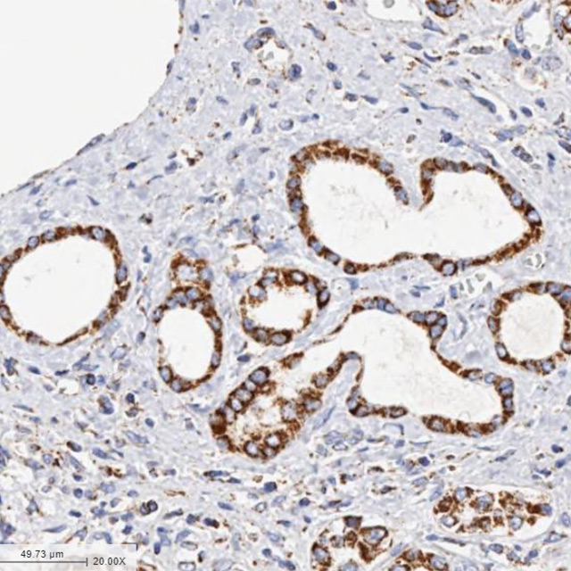 Severe Alcoholic Hepatitis Liver Sample